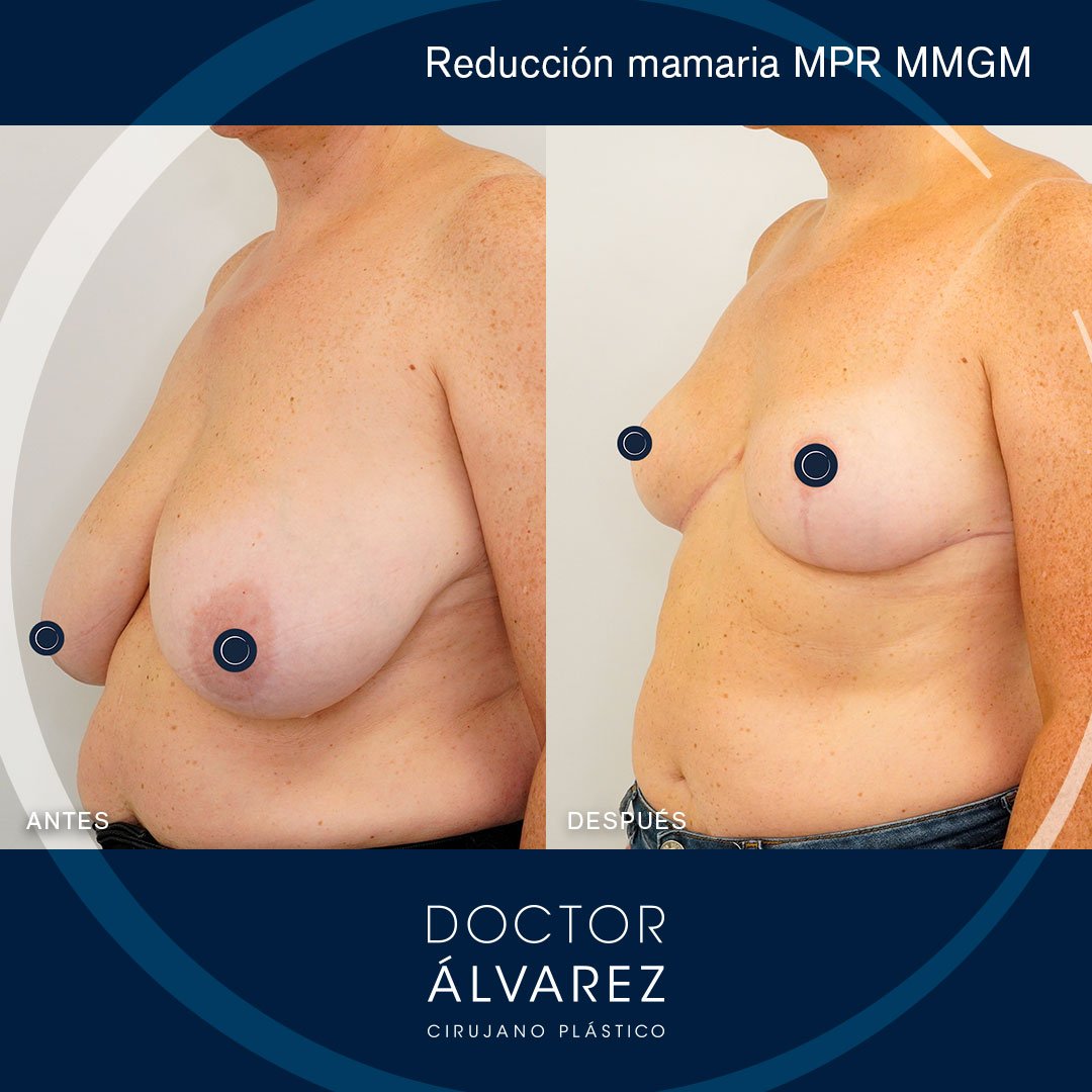 https://cirugiaesteticaplastica.es/reduccion-mamaria-mejora-estetica-y-calidad-de-vida/