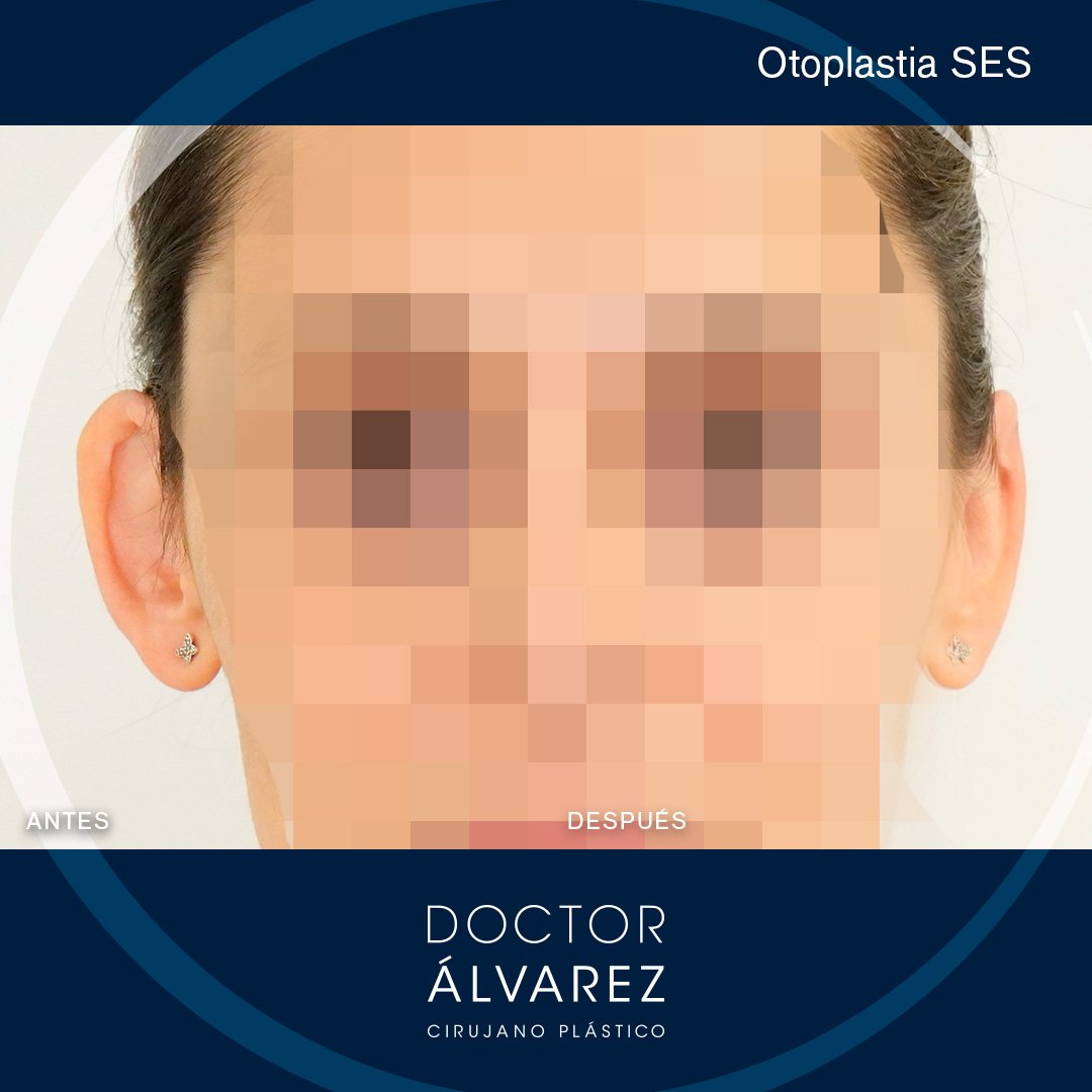 https://cirugiaesteticaplastica.es/otoplastia-para-corregir-orejas-prominentes/