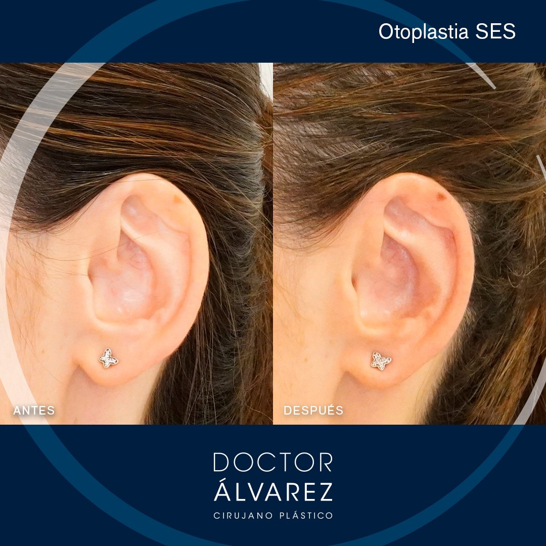 https://cirugiaesteticaplastica.es/otoplastia-para-corregir-orejas-prominentes/