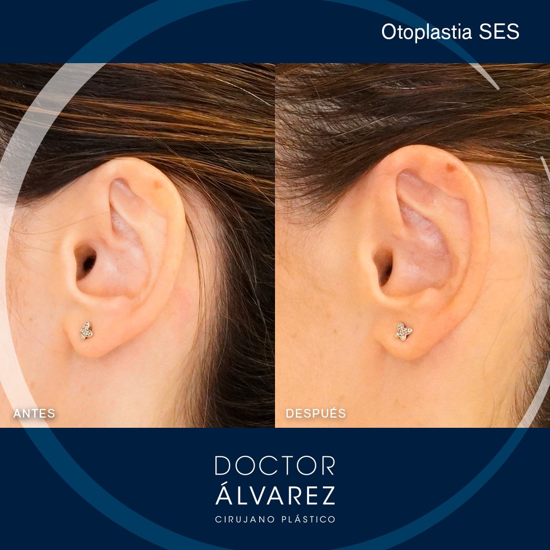 https://cirugiaesteticaplastica.es/otoplastia-para-corregir-orejas-prominentes/