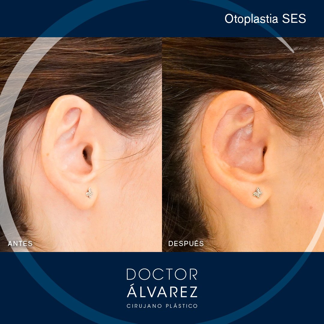https://cirugiaesteticaplastica.es/otoplastia-para-corregir-orejas-prominentes/