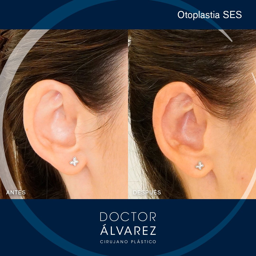 https://cirugiaesteticaplastica.es/otoplastia-para-corregir-orejas-prominentes/