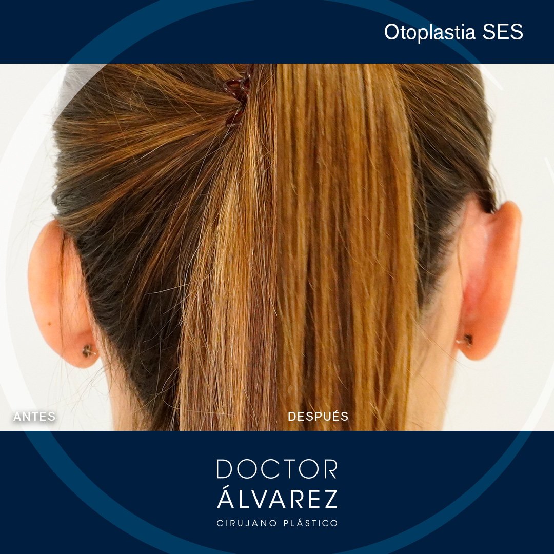 https://cirugiaesteticaplastica.es/otoplastia-para-corregir-orejas-prominentes/