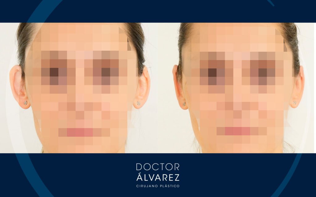 Antes y después de una cirugía de otoplastia