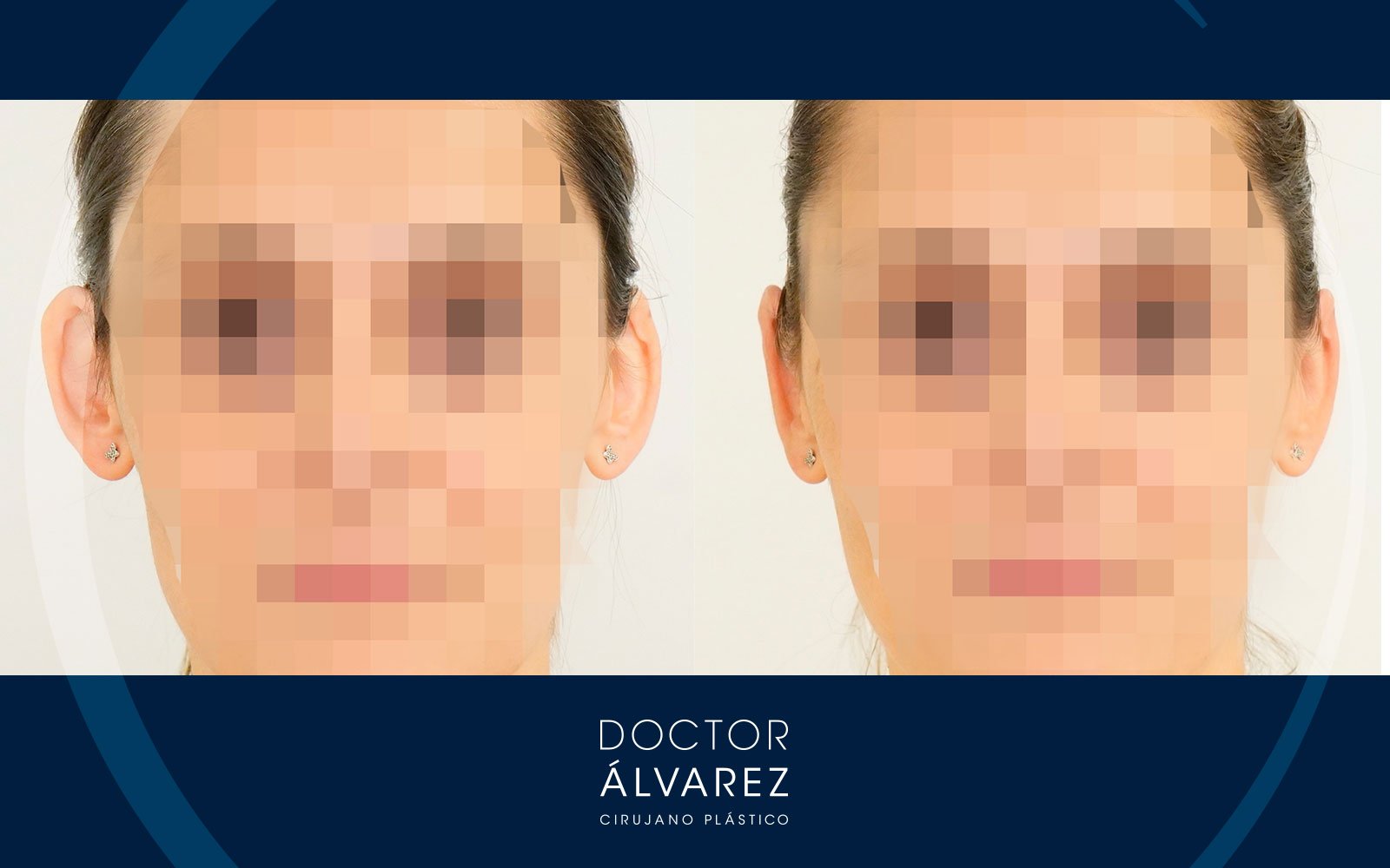 Otoplastia para corregir orejas prominentes